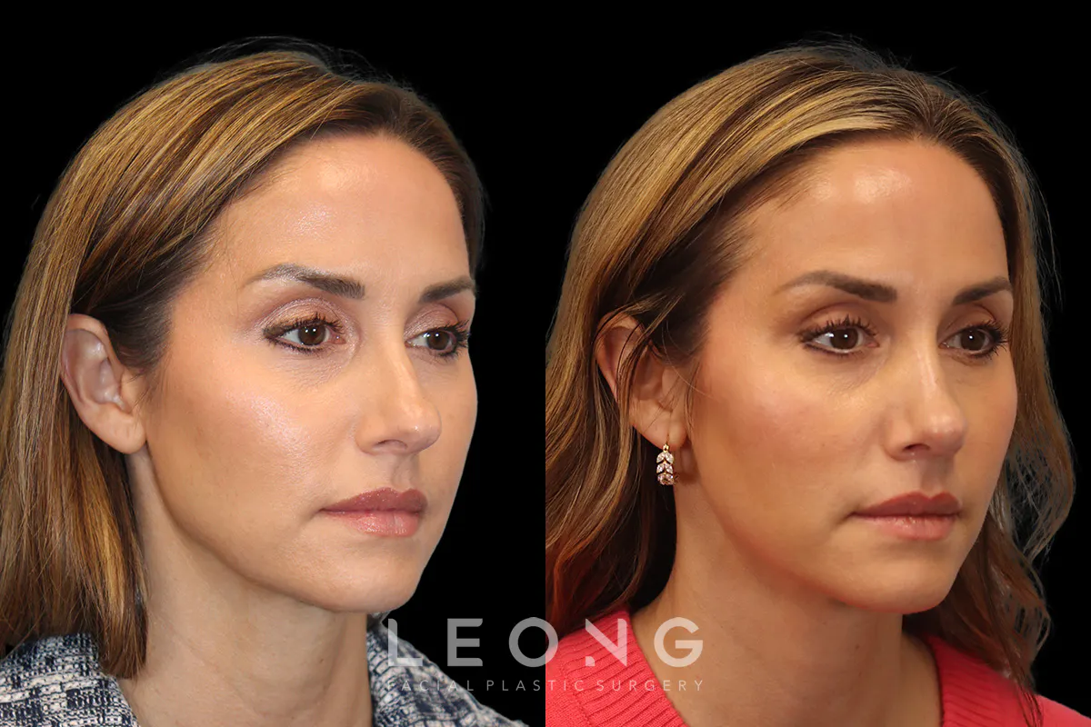 Nose Before and After | Leong Facial Plastic Surgery