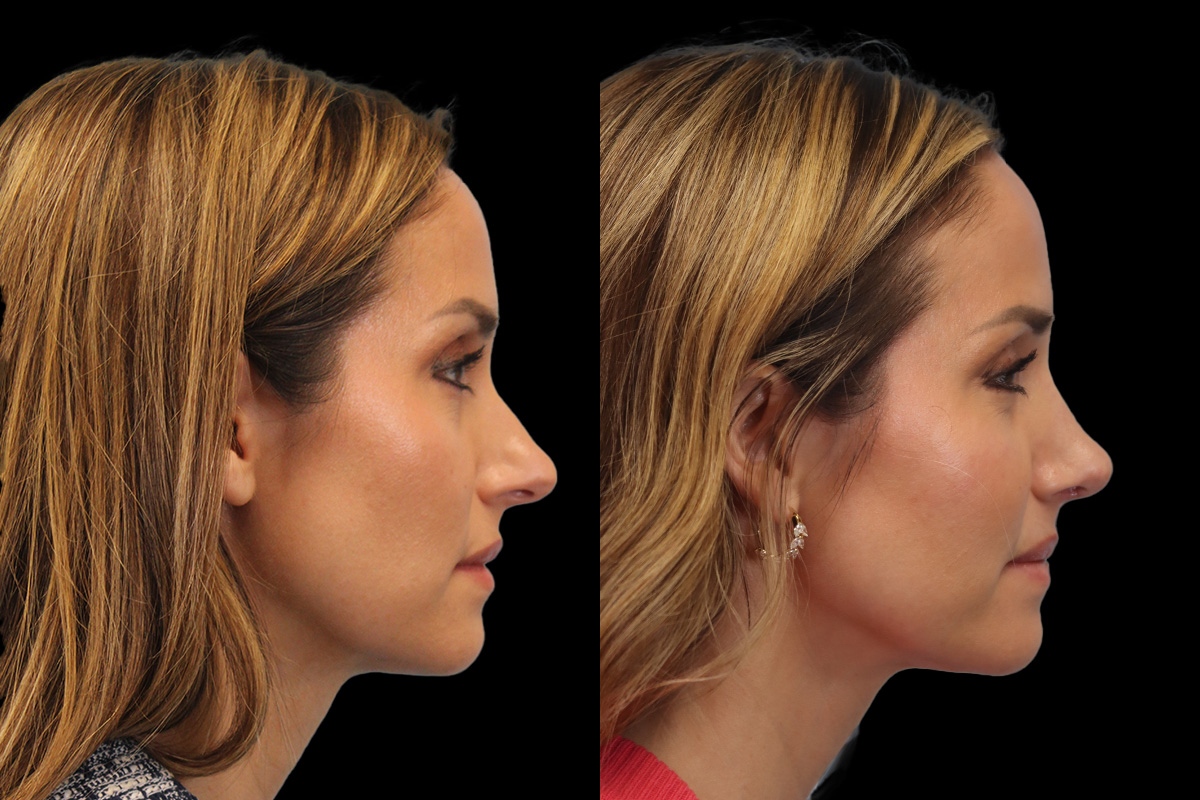 Nose Before and After | Leong Facial Plastic Surgery