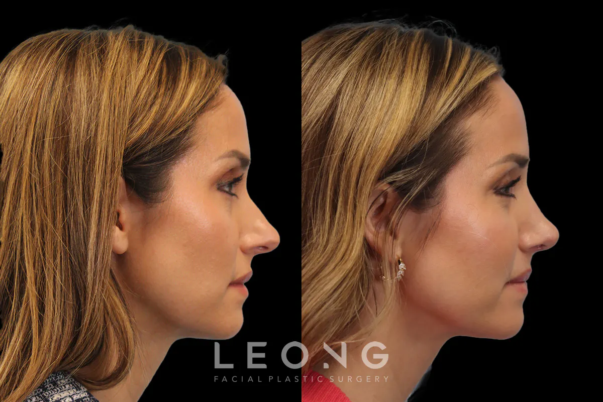 Nose Before and After | Leong Facial Plastic Surgery