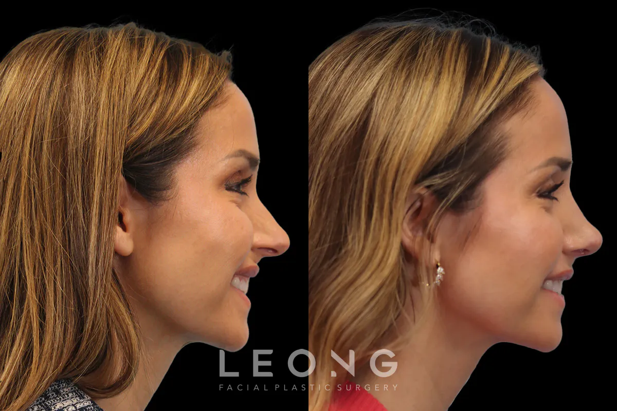 Nose Before and After | Leong Facial Plastic Surgery