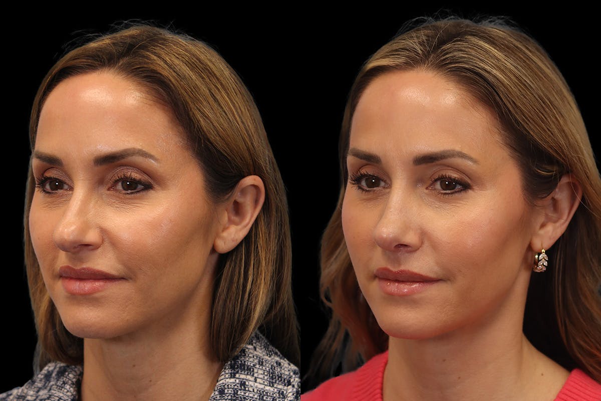 Nose Before and After | Leong Facial Plastic Surgery