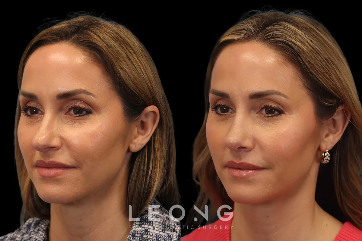 Nose Before and After | Leong Facial Plastic Surgery