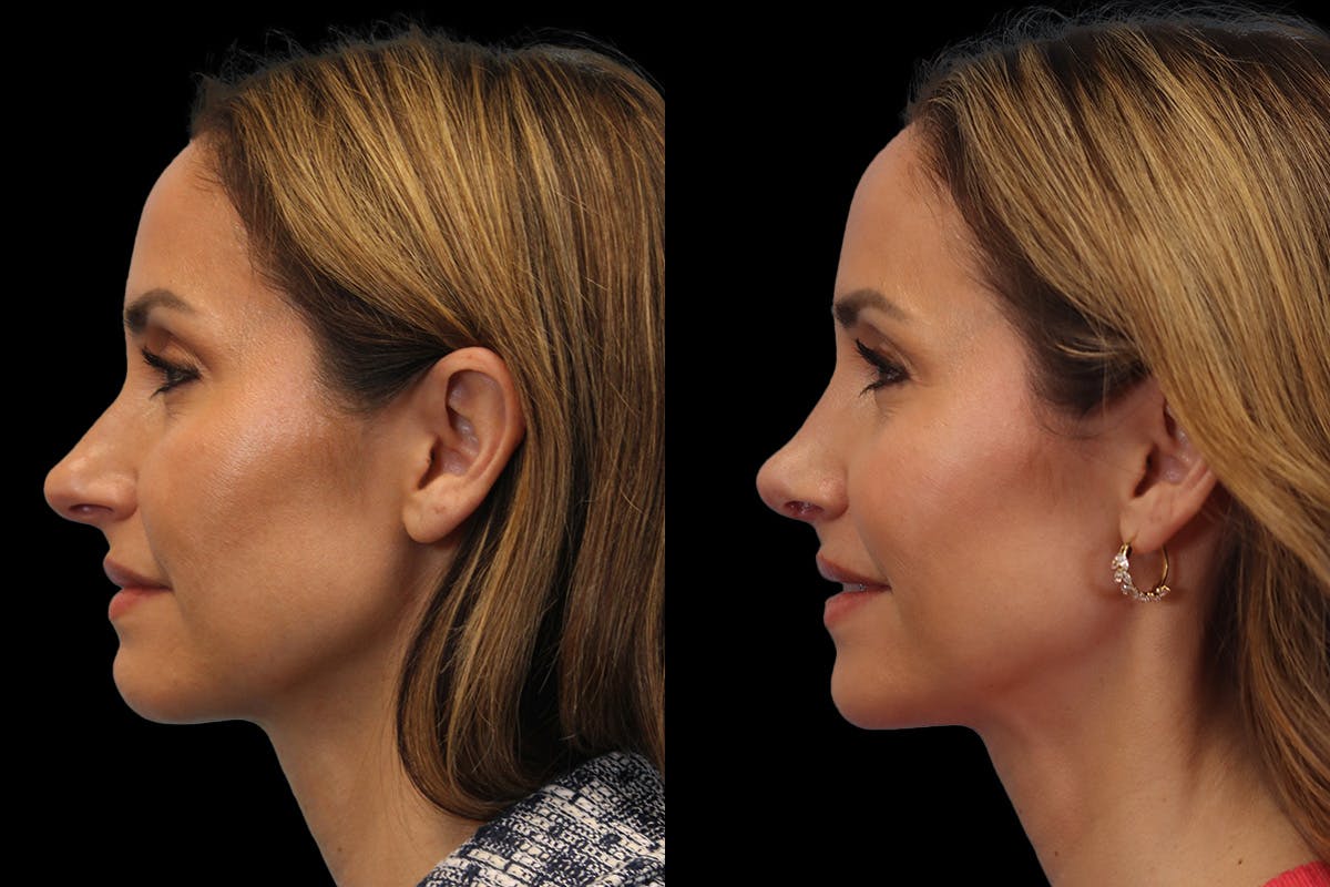 Nose Before and After | Leong Facial Plastic Surgery