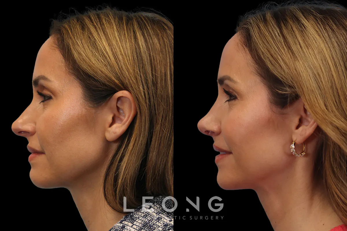 Nose Before and After | Leong Facial Plastic Surgery