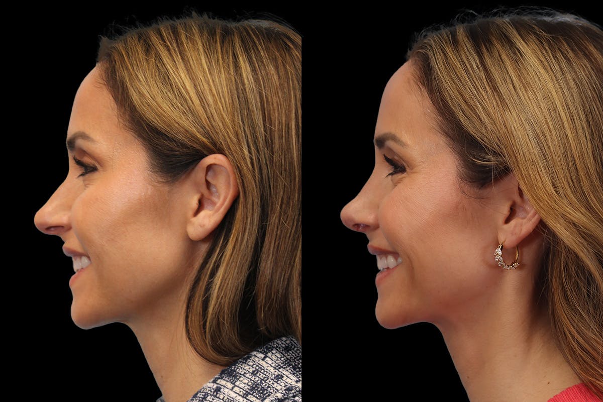 Nose Before and After | Leong Facial Plastic Surgery