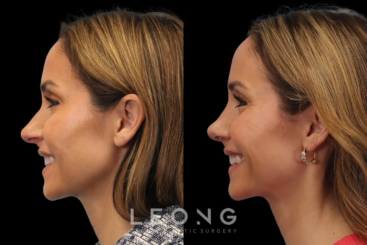 Nose Before and After | Leong Facial Plastic Surgery
