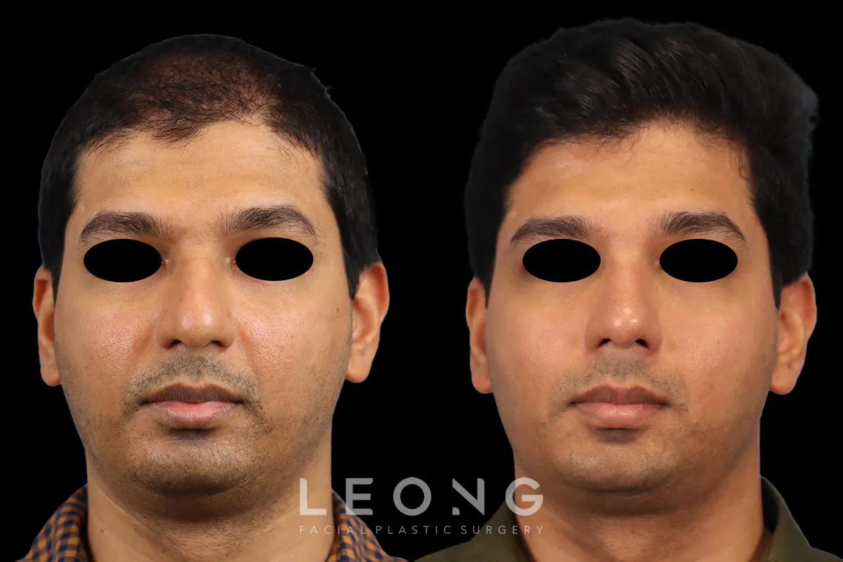 Nose Before and After | Leong Facial Plastic Surgery