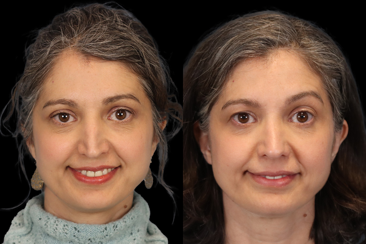 Nose Before and After | Leong Facial Plastic Surgery