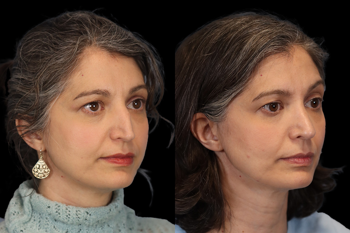 Nose Before and After | Leong Facial Plastic Surgery