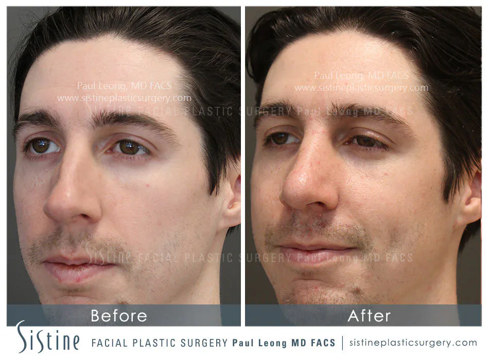 Nose Before and After | Leong Facial Plastic Surgery