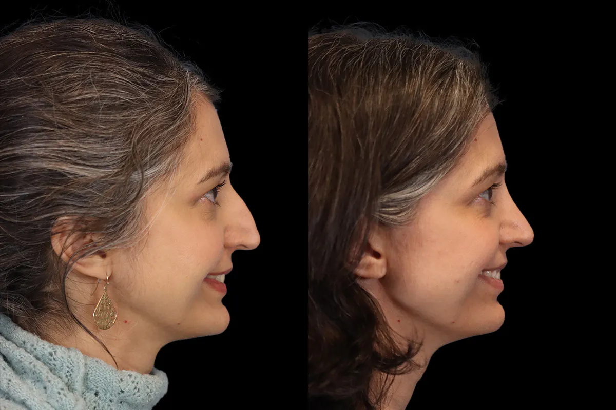 Nose Before and After | Leong Facial Plastic Surgery