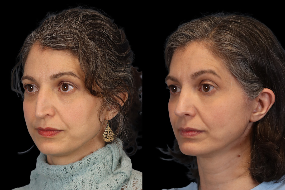 Nose Before and After | Leong Facial Plastic Surgery
