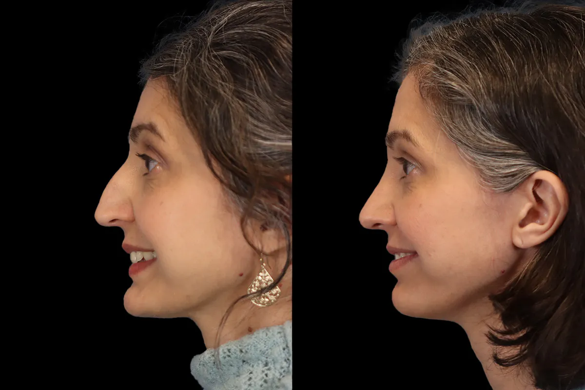 Nose Before and After | Leong Facial Plastic Surgery