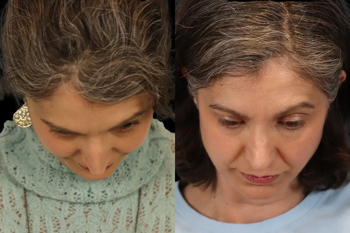 Nose Before and After | Leong Facial Plastic Surgery