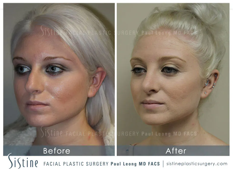 Nose Before and After | Leong Facial Plastic Surgery