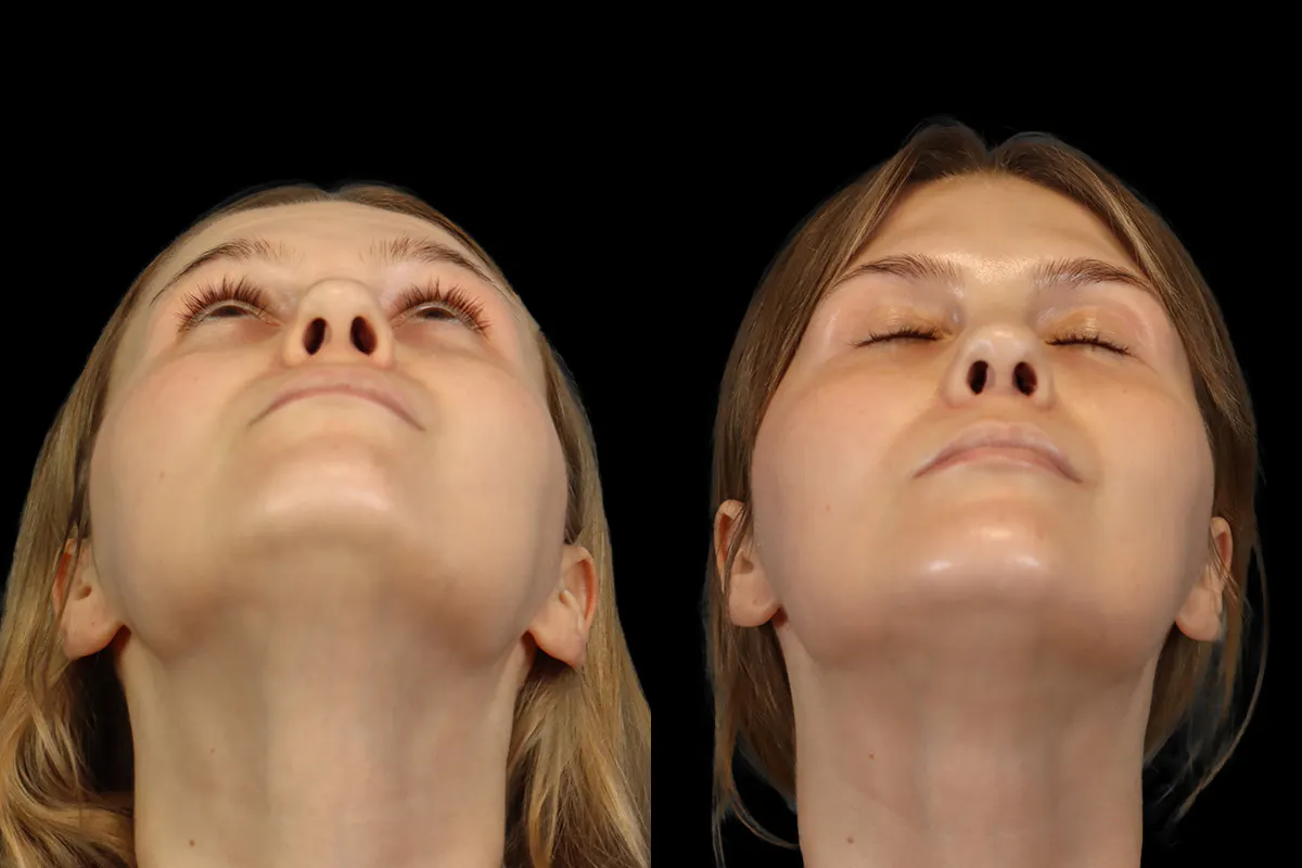 Nose Before and After | Leong Facial Plastic Surgery