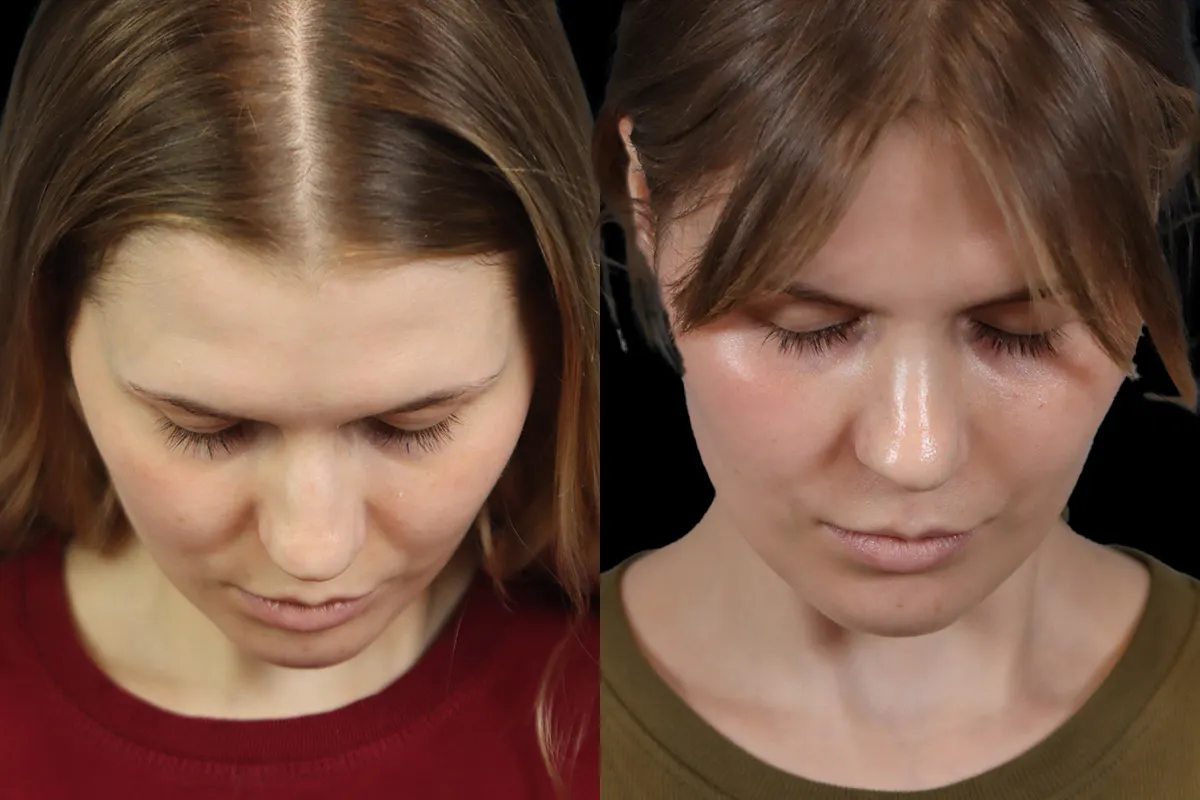 Nose Before and After | Leong Facial Plastic Surgery