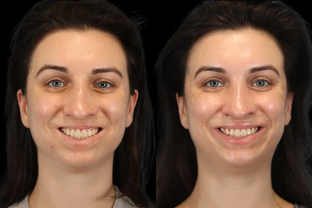 Nose Before and After | Leong Facial Plastic Surgery