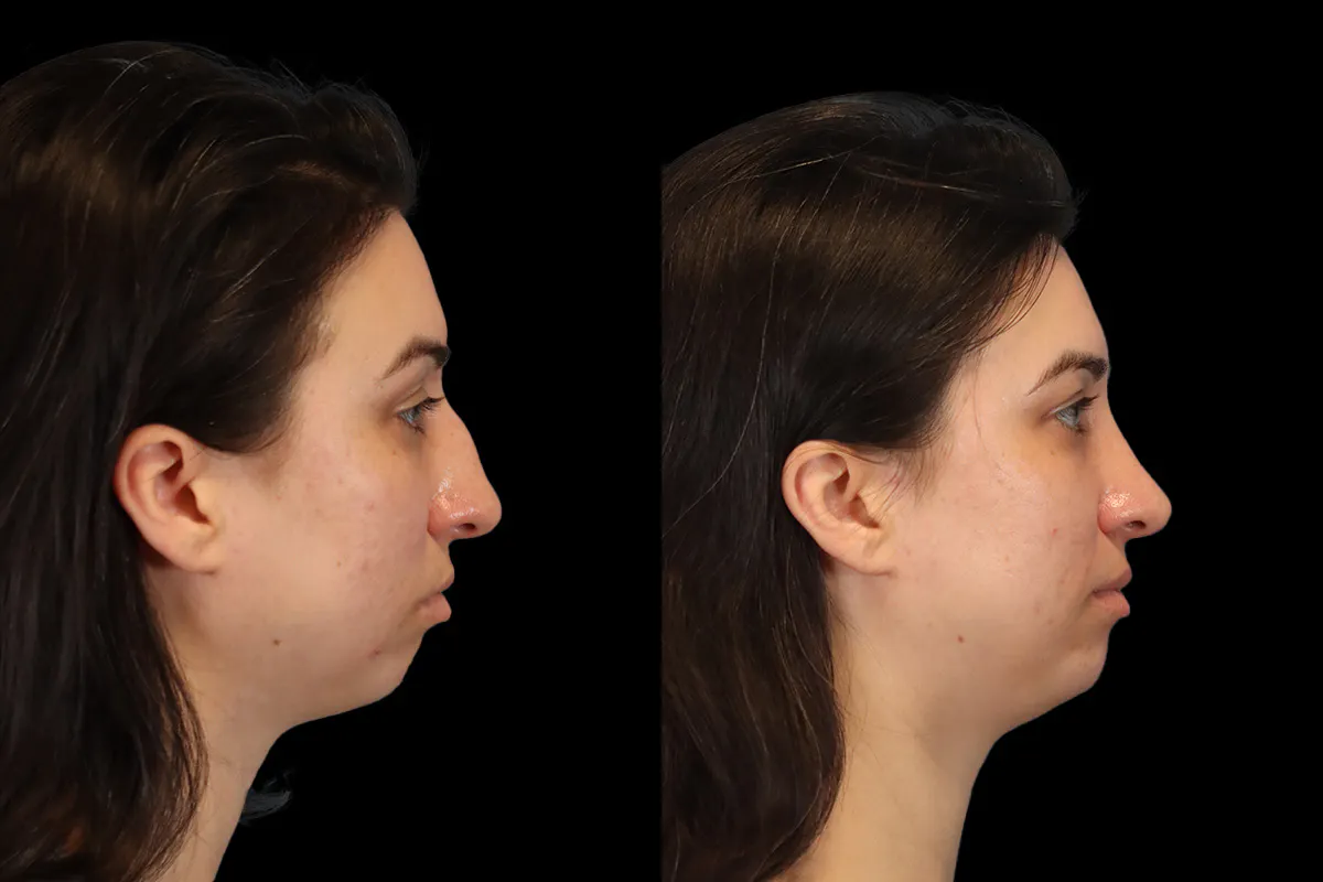 Nose Before and After | Leong Facial Plastic Surgery