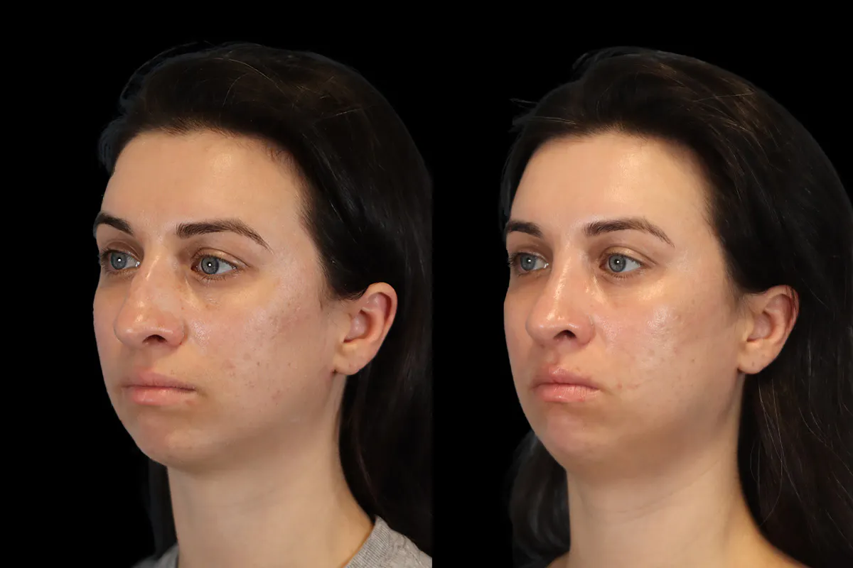 Nose Before and After | Leong Facial Plastic Surgery