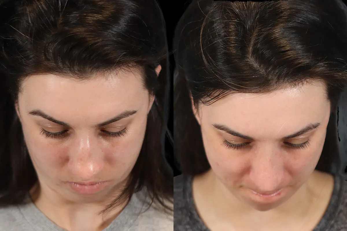 Nose Before and After | Leong Facial Plastic Surgery