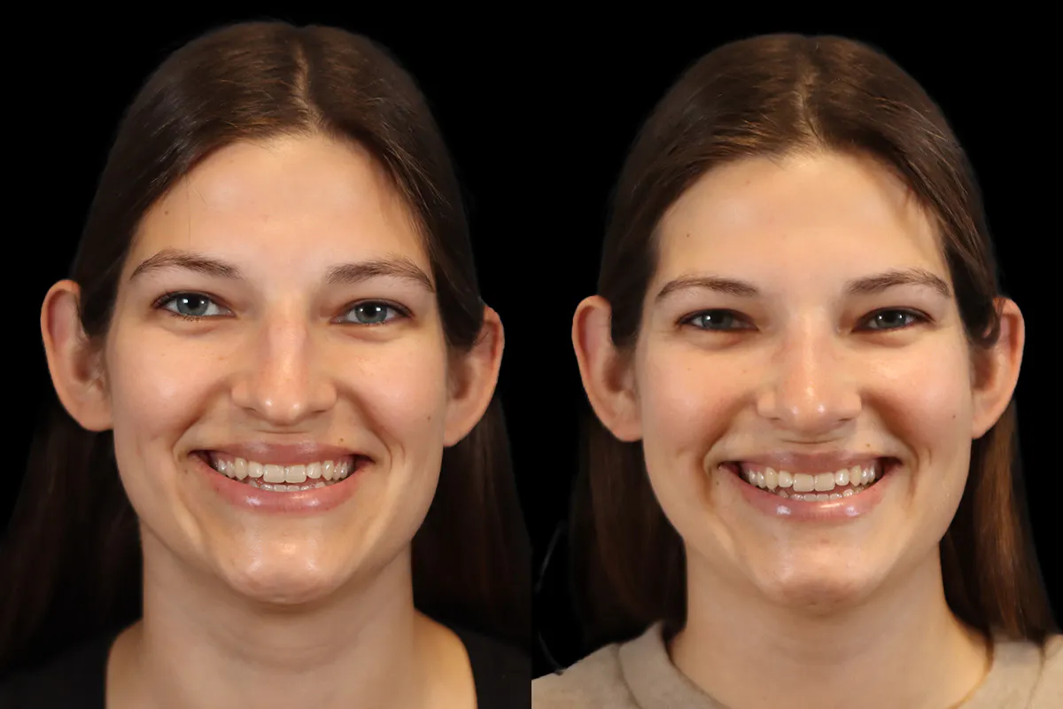 Nose Before and After | Leong Facial Plastic Surgery