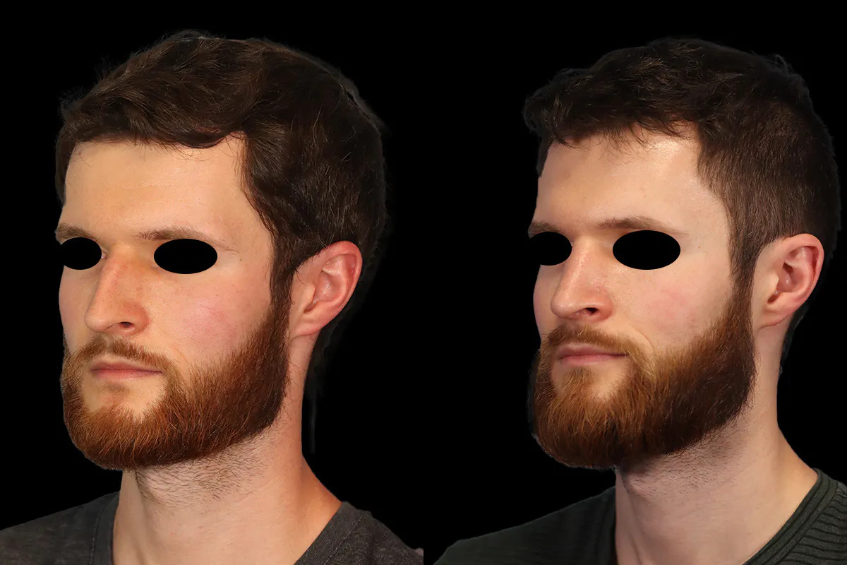 Nose Before and After | Leong Facial Plastic Surgery