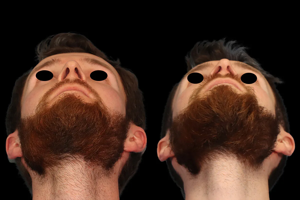 Nose Before and After | Leong Facial Plastic Surgery