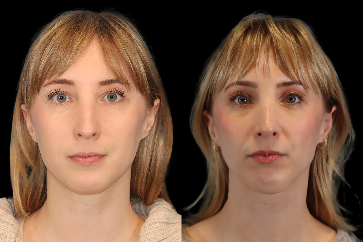 Nose Before and After | Leong Facial Plastic Surgery