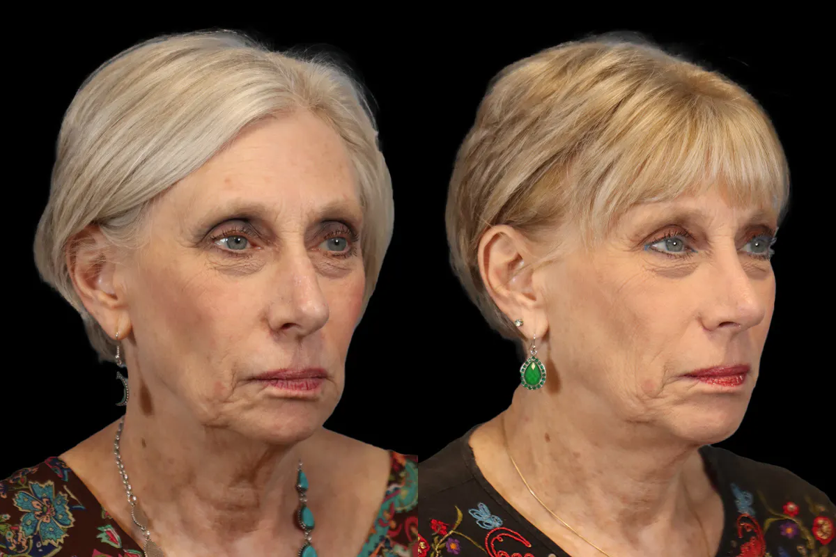 Nose Before and After | Leong Facial Plastic Surgery