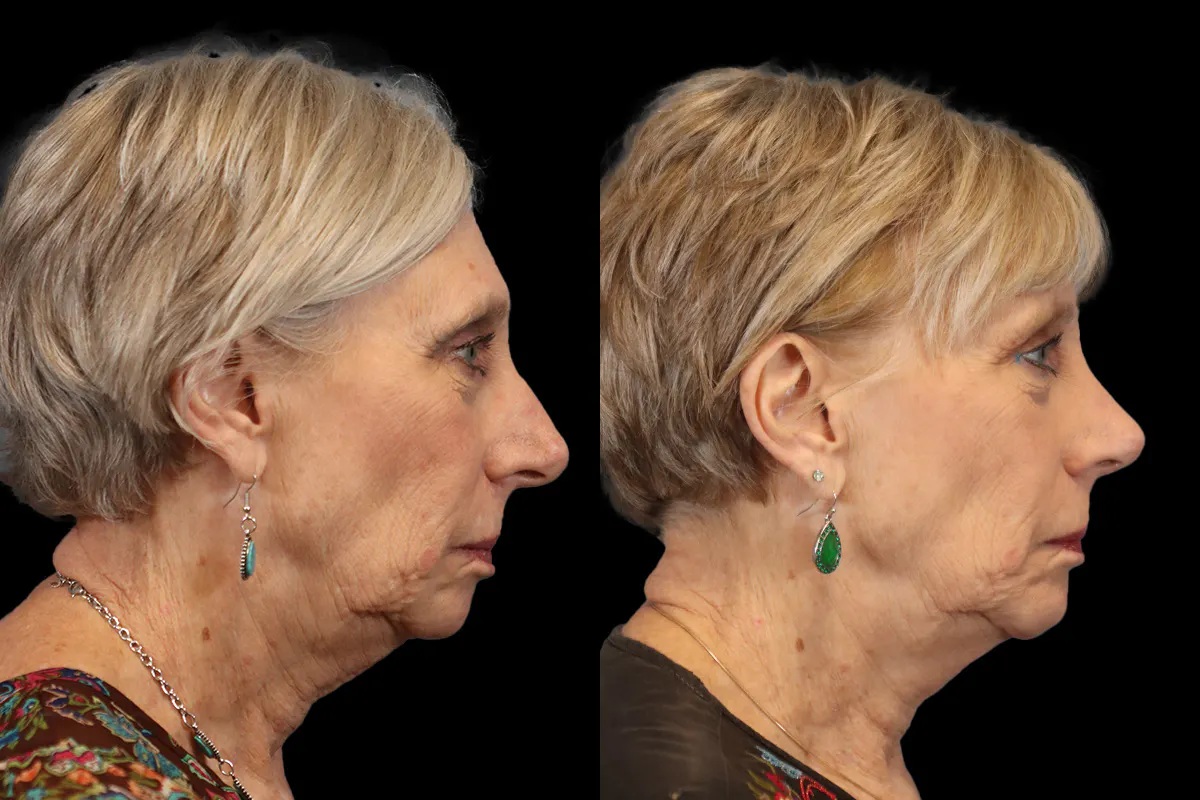 Nose Before and After | Leong Facial Plastic Surgery