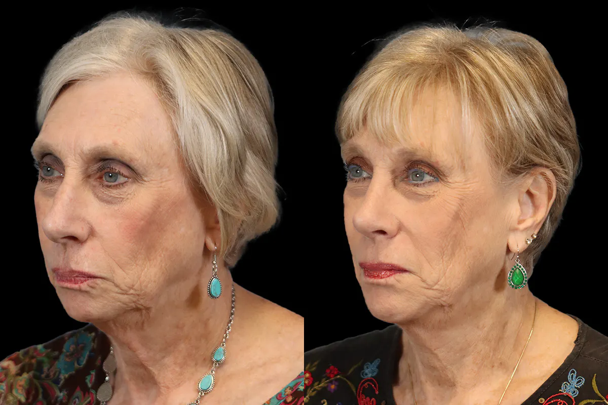 Nose Before and After | Leong Facial Plastic Surgery