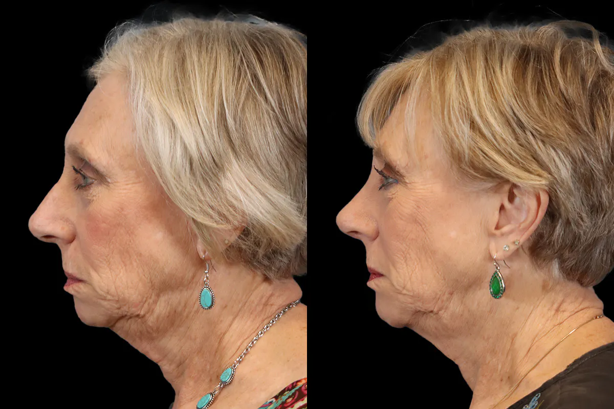 Nose Before and After | Leong Facial Plastic Surgery