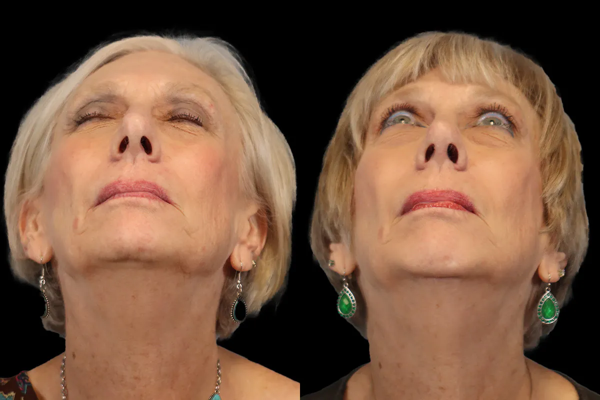 Nose Before and After | Leong Facial Plastic Surgery