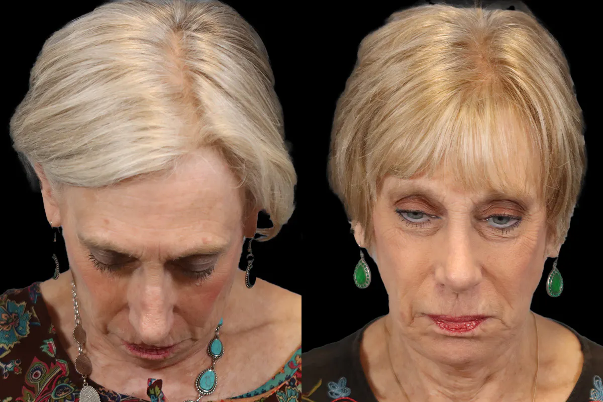 Nose Before and After | Leong Facial Plastic Surgery