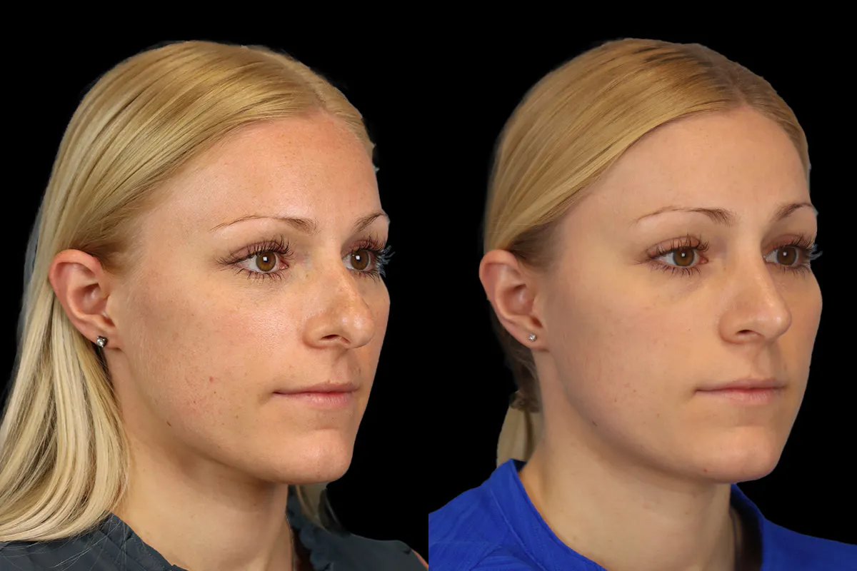 Nose Before and After | Leong Facial Plastic Surgery