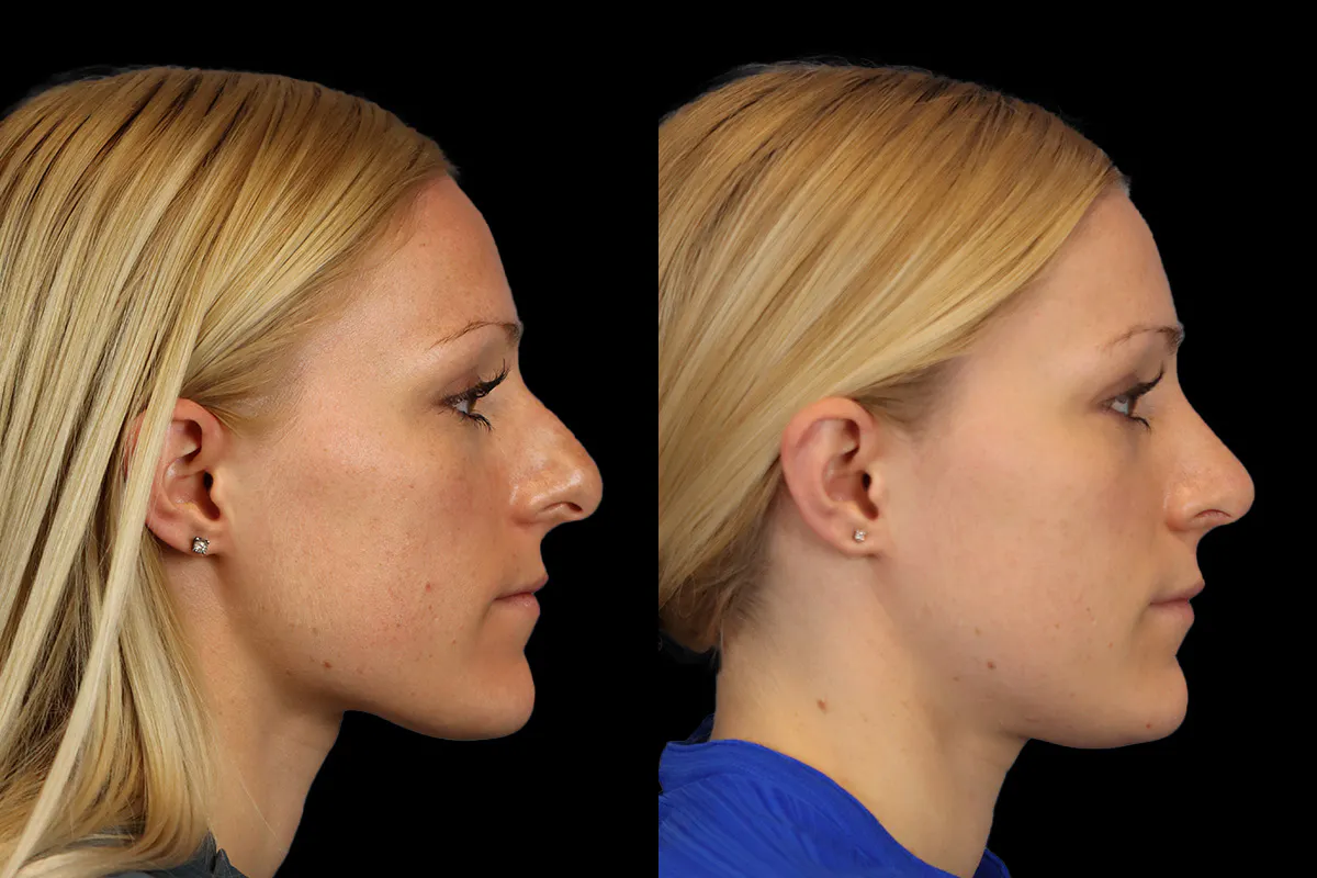 Nose Before and After | Leong Facial Plastic Surgery