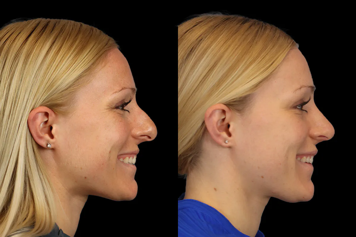 Nose Before and After | Leong Facial Plastic Surgery