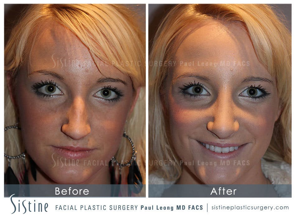 Nose Before and After | Leong Facial Plastic Surgery