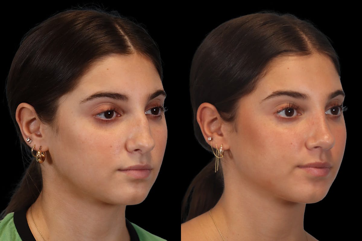 Nose Before and After | Leong Facial Plastic Surgery