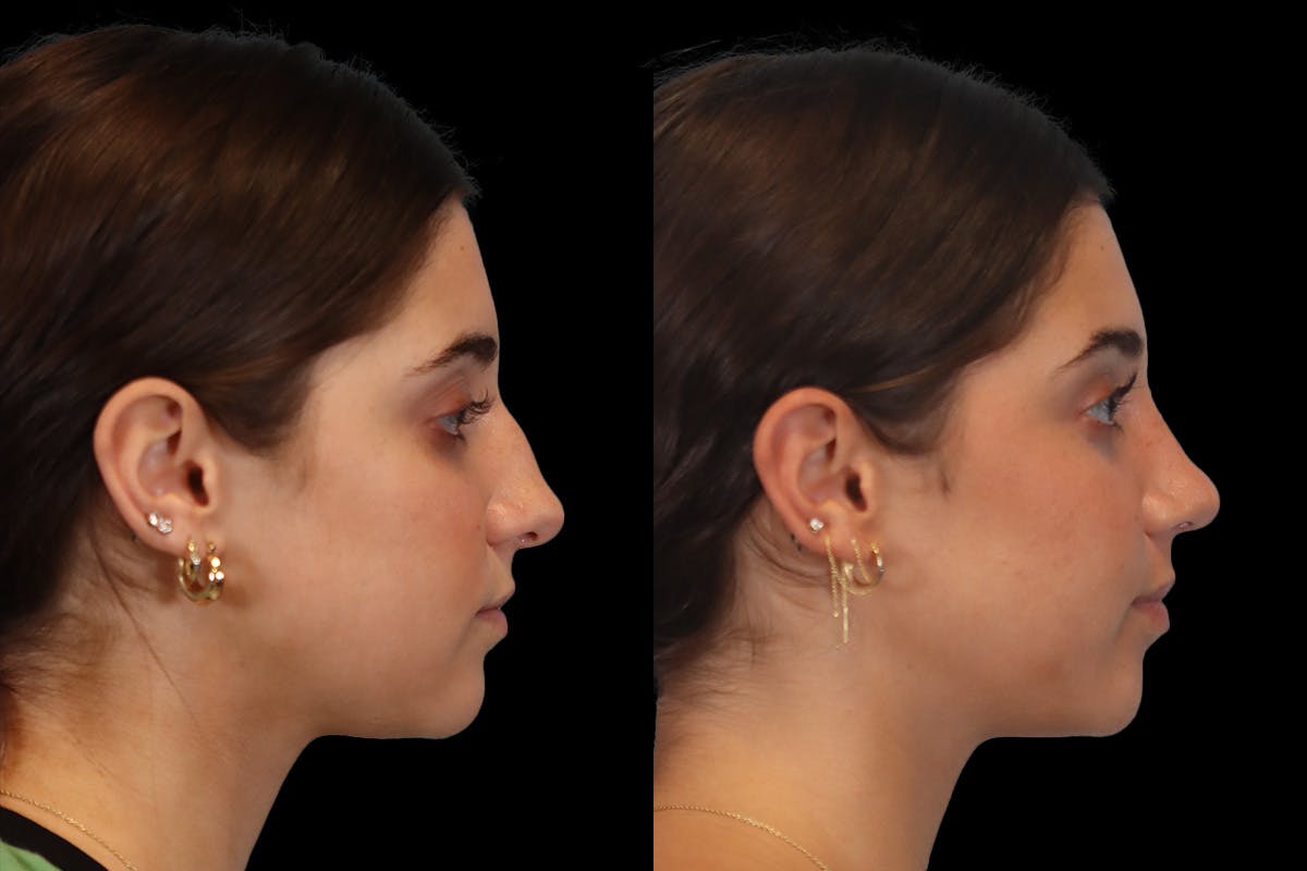 Nose Before and After | Leong Facial Plastic Surgery