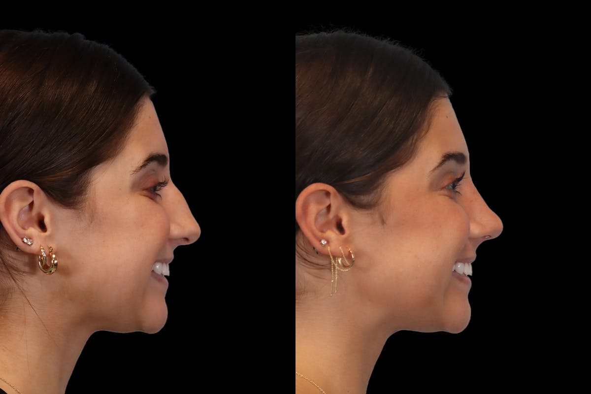 Nose Before and After | Leong Facial Plastic Surgery