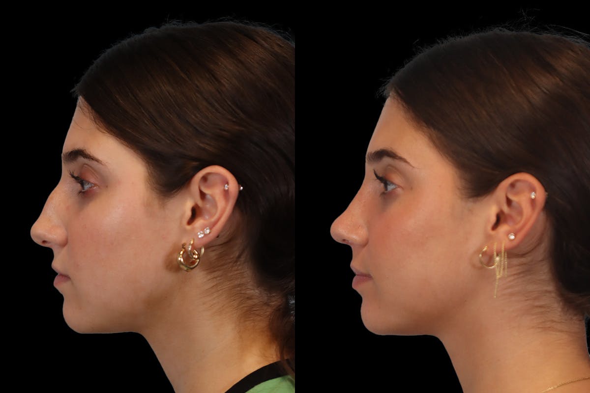 Nose Before and After | Leong Facial Plastic Surgery