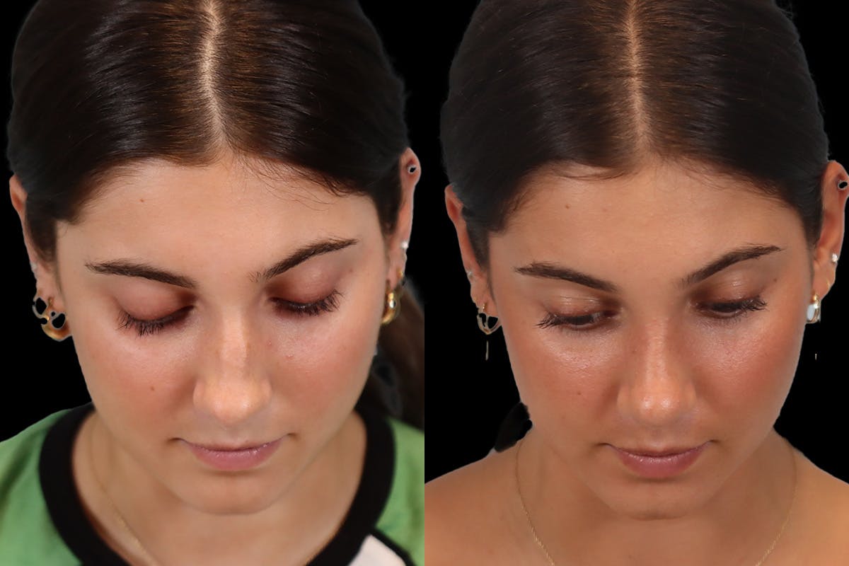 Nose Before and After | Leong Facial Plastic Surgery