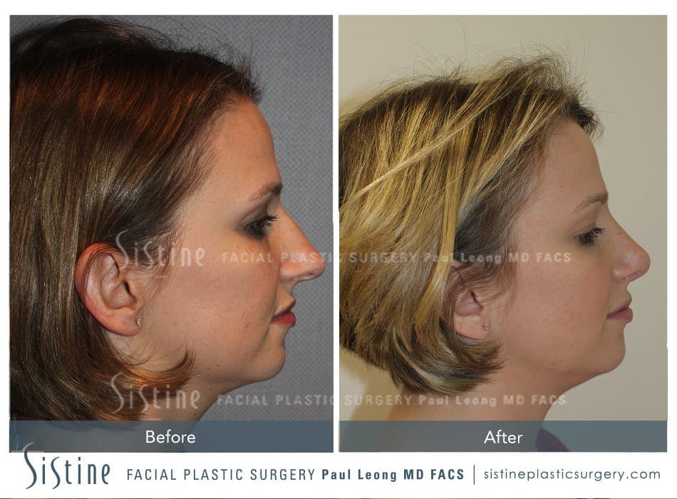 Nose Before and After | Leong Facial Plastic Surgery