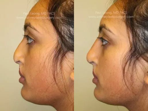 Nose Before and After | Leong Facial Plastic Surgery