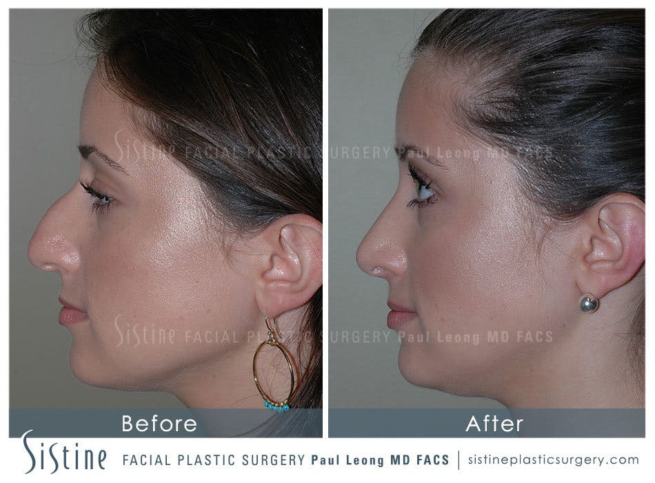 Nose Before and After | Leong Facial Plastic Surgery