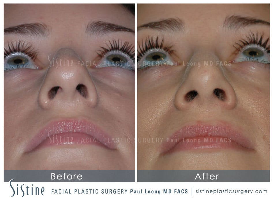 Nose Before and After | Leong Facial Plastic Surgery