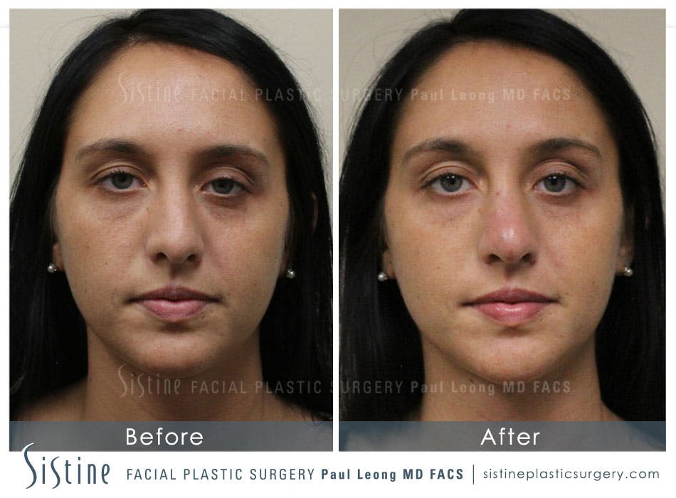 Nose Before and After | Leong Facial Plastic Surgery