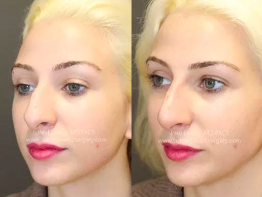 Nose Before and After | Leong Facial Plastic Surgery